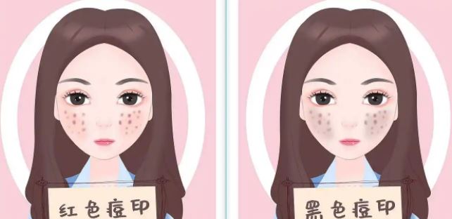 臉上紅色痘印幾個(gè)月都不消怎么辦？紅色痘印應(yīng)該怎么消除？