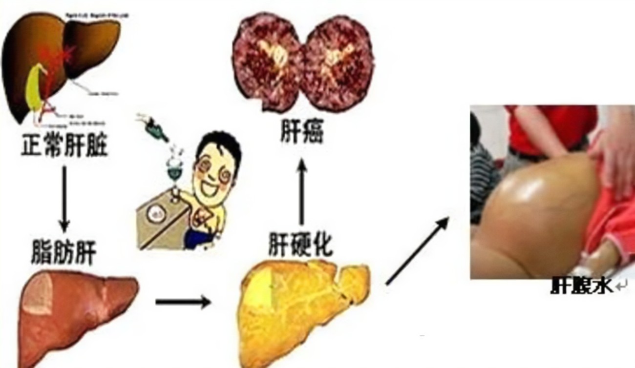 查出肝硬化還有救嗎？