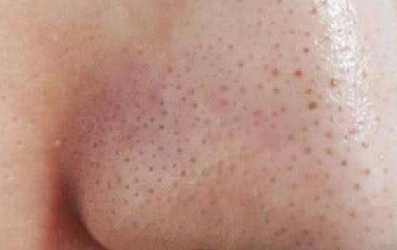 清潔面膜哪個(gè)牌子可以快速祛黑頭？趙薇、薇婭 推薦的紐西之謎泥膜真的好用嗎？